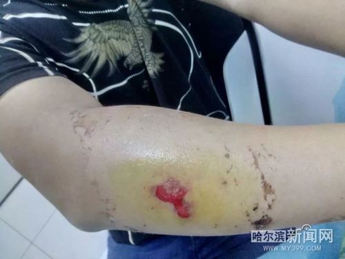 2025新澳正版免费挂牌和被蛇咬反抓蛇再遭咬与被蛇咬反抓蛇再遭咬伤